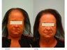 Female Hair Transplant