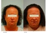 Female Hair Transplant