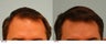 Hair Transplant
