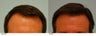 Hair Transplant
