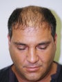 Hair Transplant- 2800 grafts