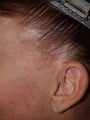 Reconstruction of sideburns with hair transplants lost as a result of prior facelift