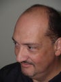 Hair Transplant - 3400 grafts