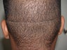 Hair Transplant - FUE 350 grafts