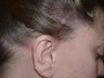 Hair Transplant / 850 grafts to temple