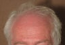 Neograft hair transplant no linear scalp scar!