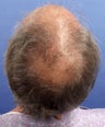 Hair Restoration