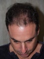 Hair Transplant