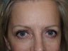 Eyebrow Transplantation