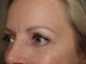 Eyebrow Transplantation