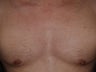 Chest Hair Transplant