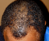 FUE Neograft hair transplant African American