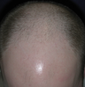 Hair Transplant