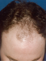 Hair Transplant