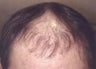 Hair Transplant