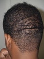 Hair Transplant - Follicular Unit Extraction