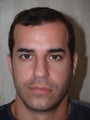 Hair Transplant