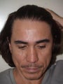 Hairline Advancement