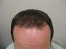 Hair Transplantation