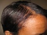 Hair Transplantation
