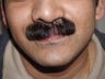 Facial Hair Transplant