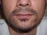 Facial Hair Transplant