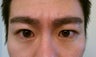 Eyebrow Transplant