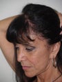 Hair Transplant