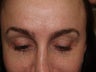 Eyebrow Transplant