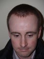 Hair Transplant