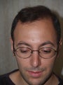 Hair Transplant