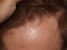 Hair Transplant Reparative Procedure