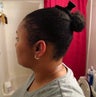 Hair Transplant