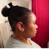 Hair Transplant 1400 Grafts