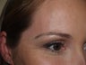 Eyebrow Transplant