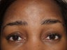 Eyebrow Transplantation