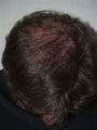 Hair Transplant