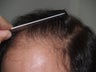 Hair Transplant