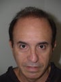 Hair Transplant