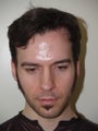 Hair Transplant