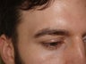Eyebrow Transplant