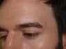 Eyebrow Transplant