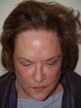 Hair Transplant