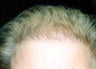 Hair Replacement