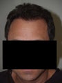 Hair Transplant