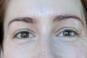 Eyebrow Transplant