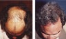 hair transplant