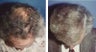 hair transplant