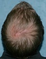 Hair transplant