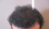 Hair Transplant
